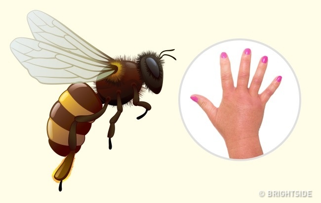 Τέσσερα συνηθισμένα τσιμπήματα από έντομα που μπορούμε να αναγνωρίσουμε (εικόνες)