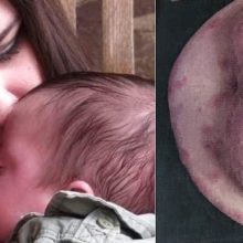 Πεμφιγοειδές της κύησης: Η παράξενη δερματική αλλεργία της εγκυμοσύνης