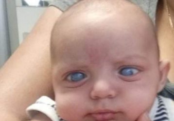 Έκκληση: Ο 4 μηνών Χρήστος- Ραφαήλ διαγνώστηκε με βαρύ συγγενές γλαύκωμα και πρέπει να χειρουργηθεί σύντομα