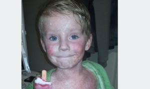 7χρονος με επώδυνη, ανίατη πάθηση χάνει το δέρμα του, αλλά όχι το χαμόγελό του