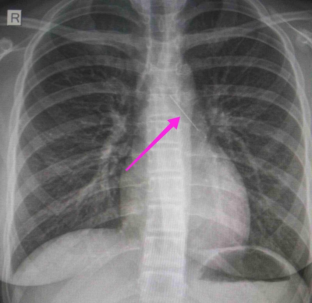 Ανήλικη κατάπιε καρφίτσα - Η αγωνιώδης προσπάθεια των γιατρών του “Ιπποκρατείου” να την σώσουν