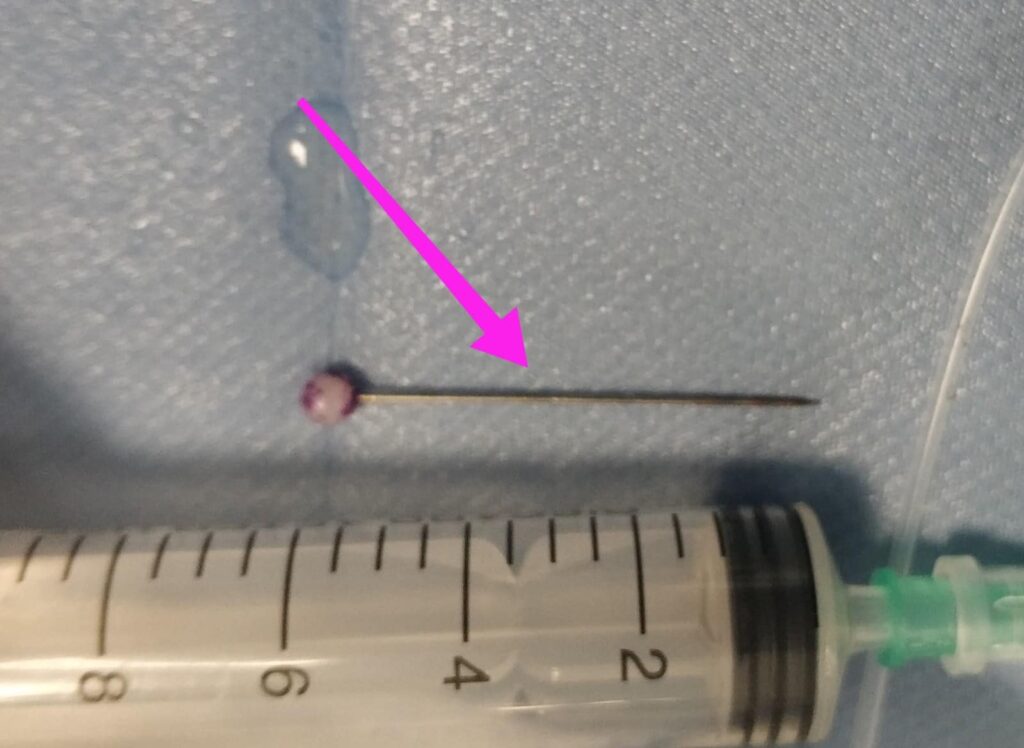 Ανήλικη κατάπιε καρφίτσα - Η αγωνιώδης προσπάθεια των γιατρών του “Ιπποκρατείου” να την σώσουν