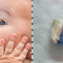 Πανικός στο Ιπποκράτειο: 16 μηνών παιδάκι κατάπιε γόμα - Πώς το έσωσαν οι γιατροί